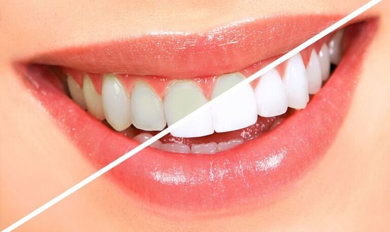 Mách bạn mẹo làm trắng răng trong 5 phút ngay tại nhà